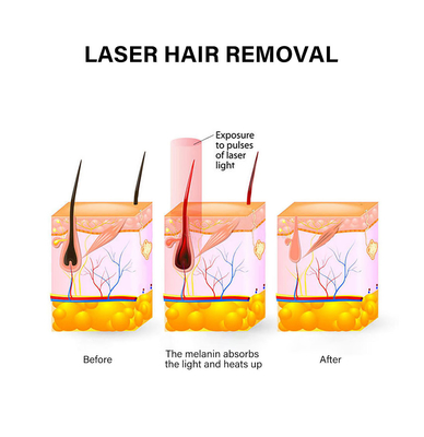 Portable Laser Hair Removal Device 810nm Permanent Hair Removal Machine For Female