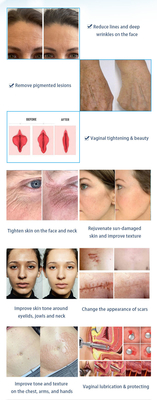 Medical Fractional CO2 Laser Machine Stationary Style for Scar Removal