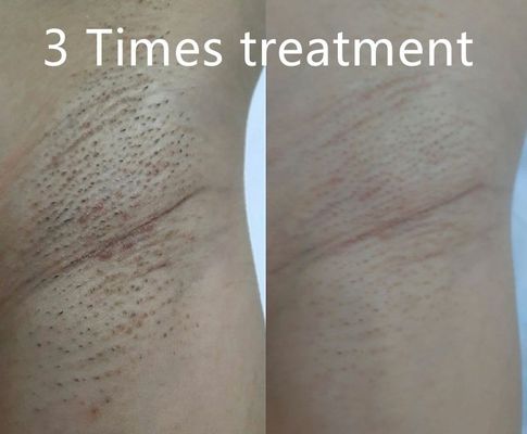 Multi Functional Diode Laser Hair Removal Device Supporting Different Pulse Widths for Tailored Permanent Hair Reduction