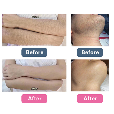 Picosecond Laser Facial Rejuvenation Machine , Q Switched Tattoo Removal Machine