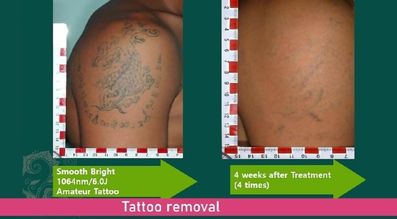 Picosecond Laser Facial Rejuvenation Machine , Q Switched Tattoo Removal Machine