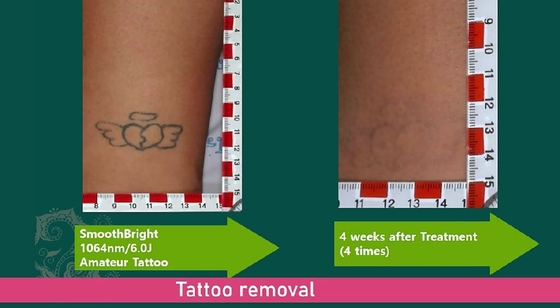 Commercial Q Switched Laser Tattoo Removal Machine 1064nm 532nm 755nm