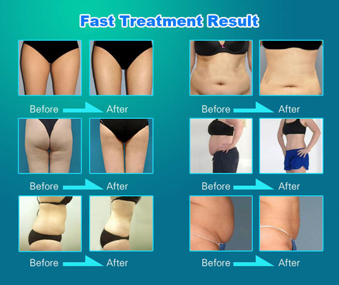 OEM / ODM Vela Slim Machine White Professional Body Contouring Machine