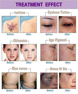 Long Pulse Nd YAG Laser Hair Removal Machine Portable For Commercial