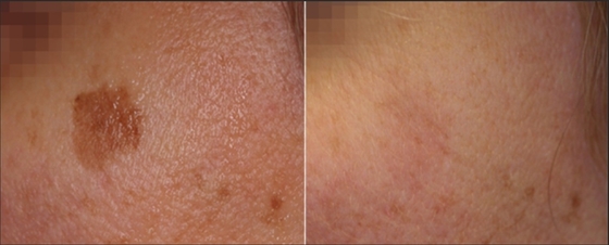3 In 1 Q Switch ND Yag Laser Machine Tattoo Removal OEM ODM Services