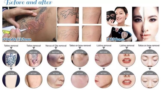 532nm 1064nm 1320nm Q Switch ND Yag Laser Machine For Skin Whitening / Dark Circles