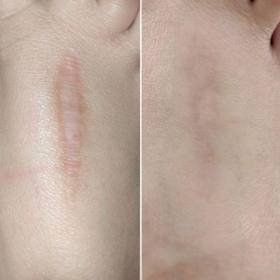 40w 60W Fractional CO2 Laser Machine For Wrinkle Removal Stretch Mark Scar Removal Tightening