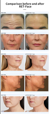 Vertical Magnetic Facial Ems rf Skin Rejuvenation Lifting Skin Tightening slimming Rf Lifting Machine machifor sal
