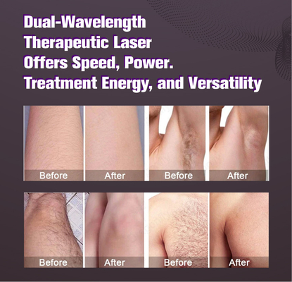 Large spot size candle laser alexandrite hair removal white hair REMOVAL 2000w alexandrite laser device