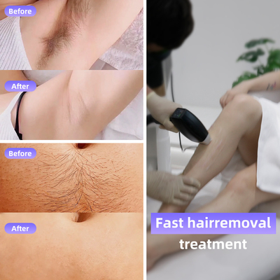 808 Diode Laser Ice Hair Removal Machine 4 Wavelengths 1064nm Changeable Spot Size Android System