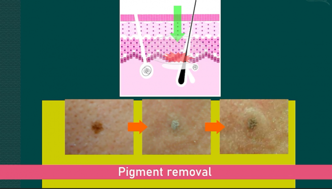 Long Pulse Nd YAG Laser Hair Removal Machine Portable For Commercial 3