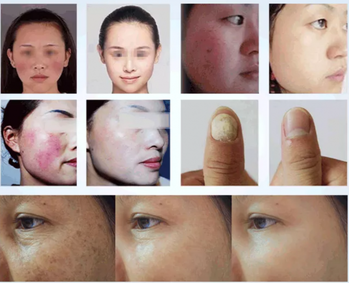 Beauty Salon 980nm Diode Laser Machine For Pain Relief / Vascular Treatment 4