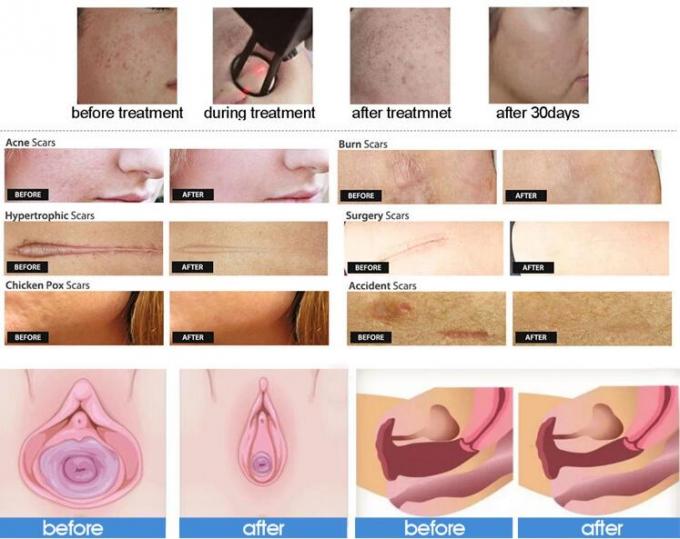 Portable CO2 Laser Fractional Machine 40W For Beauty Salon 2 Years Warranty 3