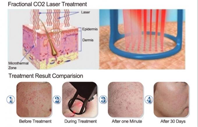 Portable CO2 Laser Fractional Machine 40W For Beauty Salon 2 Years Warranty 6