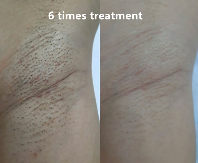 ODM OEM Portable Hair Removal Machine Diode Laser Beauty Machine 3