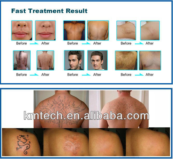 Beauty Salon IPL Laser Machine Hair Removal RF Skin Care Tattoo Removal 5