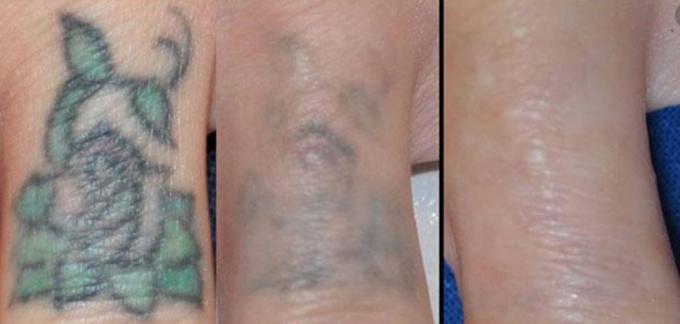 Multifunctional Q Switch ND Yag Laser Machine For Tattoo Removal / Pigmentation 3