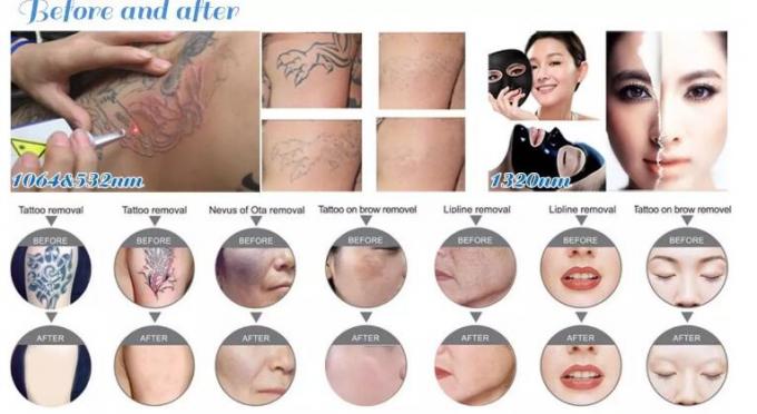 Commercial 3 In 1 Q Switch ND Yag Laser Machine With 8.4 Touch Screen 1