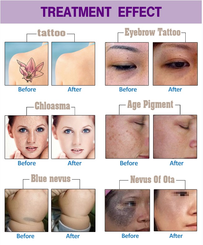 Long Pulse Nd YAG Laser Hair Removal Machine Portable For Commercial 10