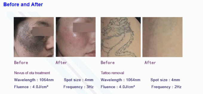 6mm YAG Bar Q Switch Laser Machine Tattoo Removal 1064nm 532nm 1320nm 1