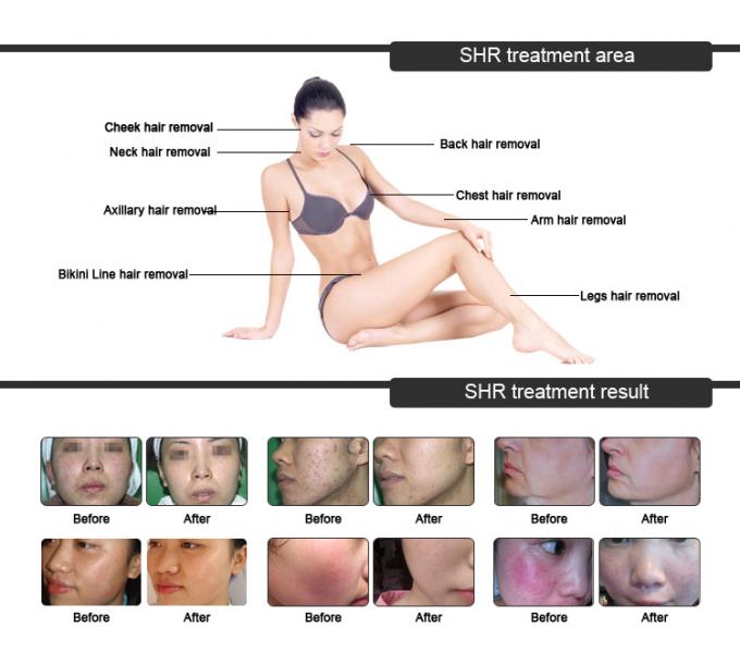 Home OPT IPL Laser Machine Permanent Skin Whitening Laser Treatment Machine 7